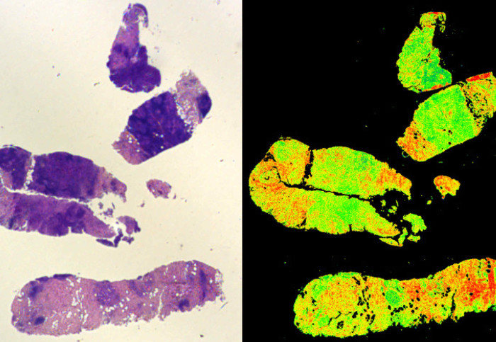 A traditionally stained biopsy (left) compared to the Digistain method (right)