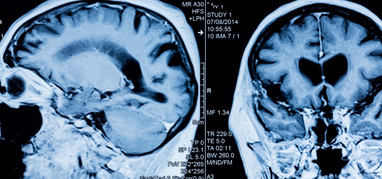 MRI head scan image